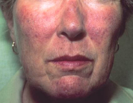 Ảnh 1 của Carcinoid syndrome